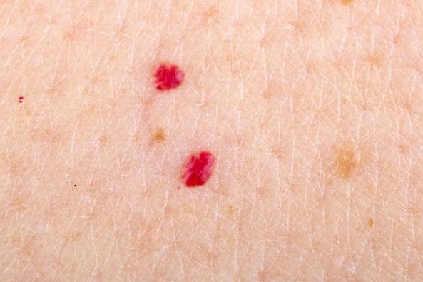 If you spot these red dots on your skin, here’s what they mean