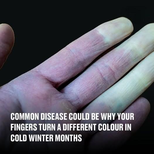 Why Do Your Fingers Change Color in Cold Weather? Understanding Raynaud’s Disease