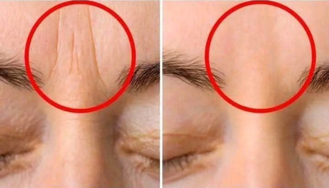 If you get wrinkles on your forehead you should know that…