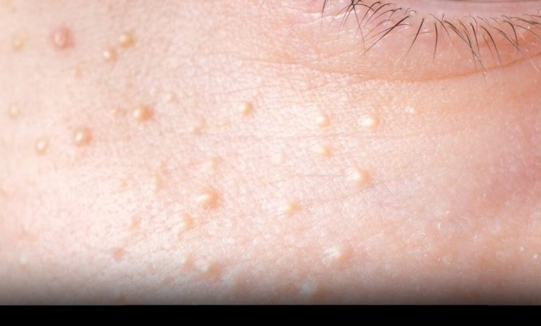 If You Have These Tiny, White Bumps on Your Face, Don’t Try to Remove Them!