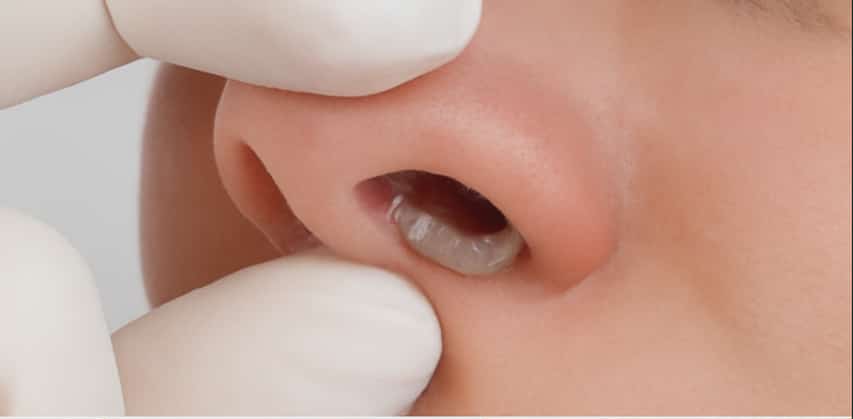Larvae in the Nose: What Is Nasal Myiasis and Can It Happen in the UK?